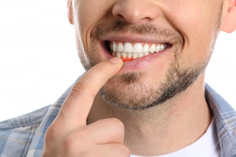 man pointing to inflamed gums
