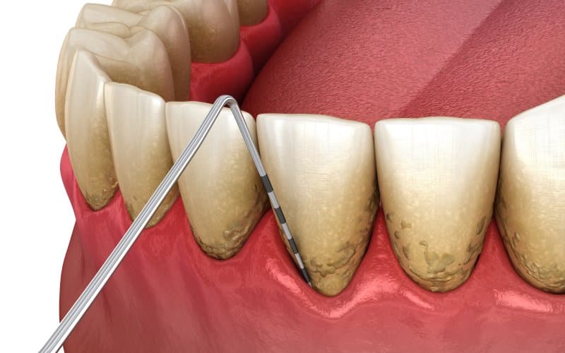 gum disease